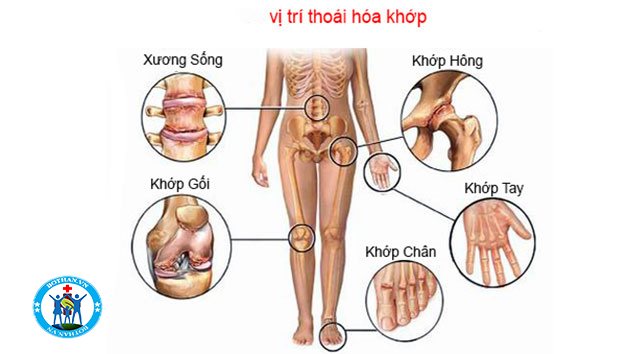 Tại sao chúng ta cần phải điều trị viêm khớp