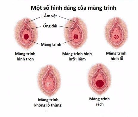 Màng trinh cơ quan sinh dục nữ mang-trinh-co-quan-sinh-duc-nu