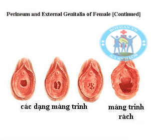 Sự so sánh các loại màng trinh phụ nữ Sự so sánh các loại màng trinh phụ nữ