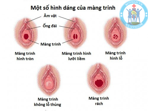 Sự so sánh các loại màng trinh phụ nữ Sự so sánh các loại màng trinh phụ nữ