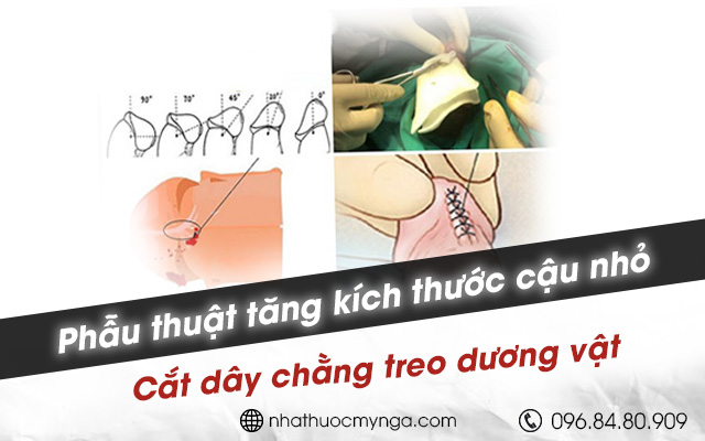 Phẫu thuật làm tăng kích thước cậu nhỏ bằng cách cắt dây chằng treo dương vật